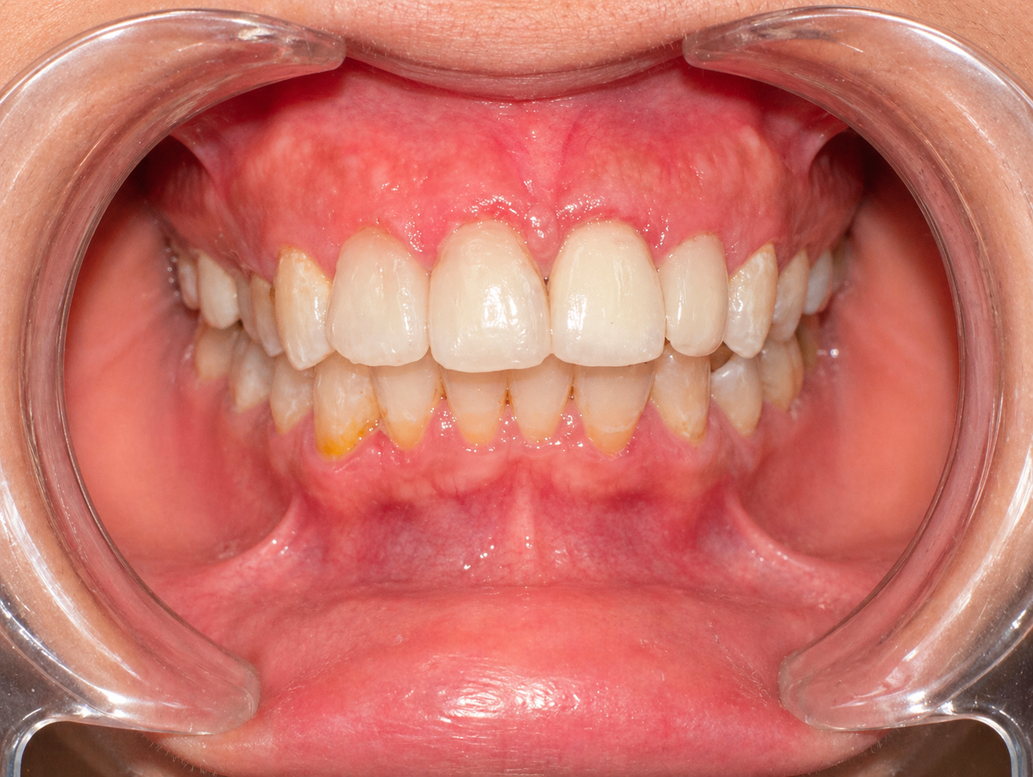 After dental treatment