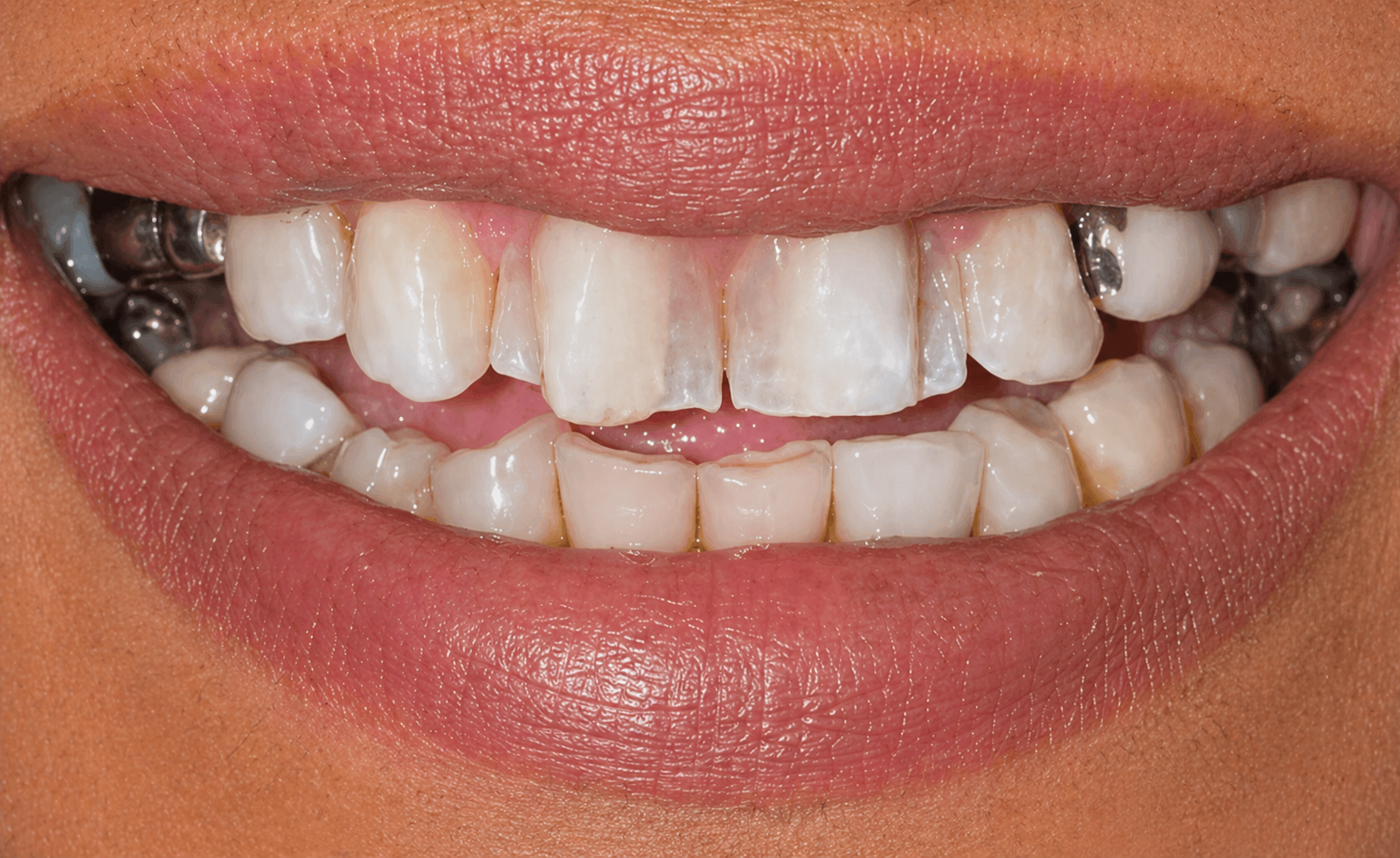 Smile alignment & aesthetic correction result
