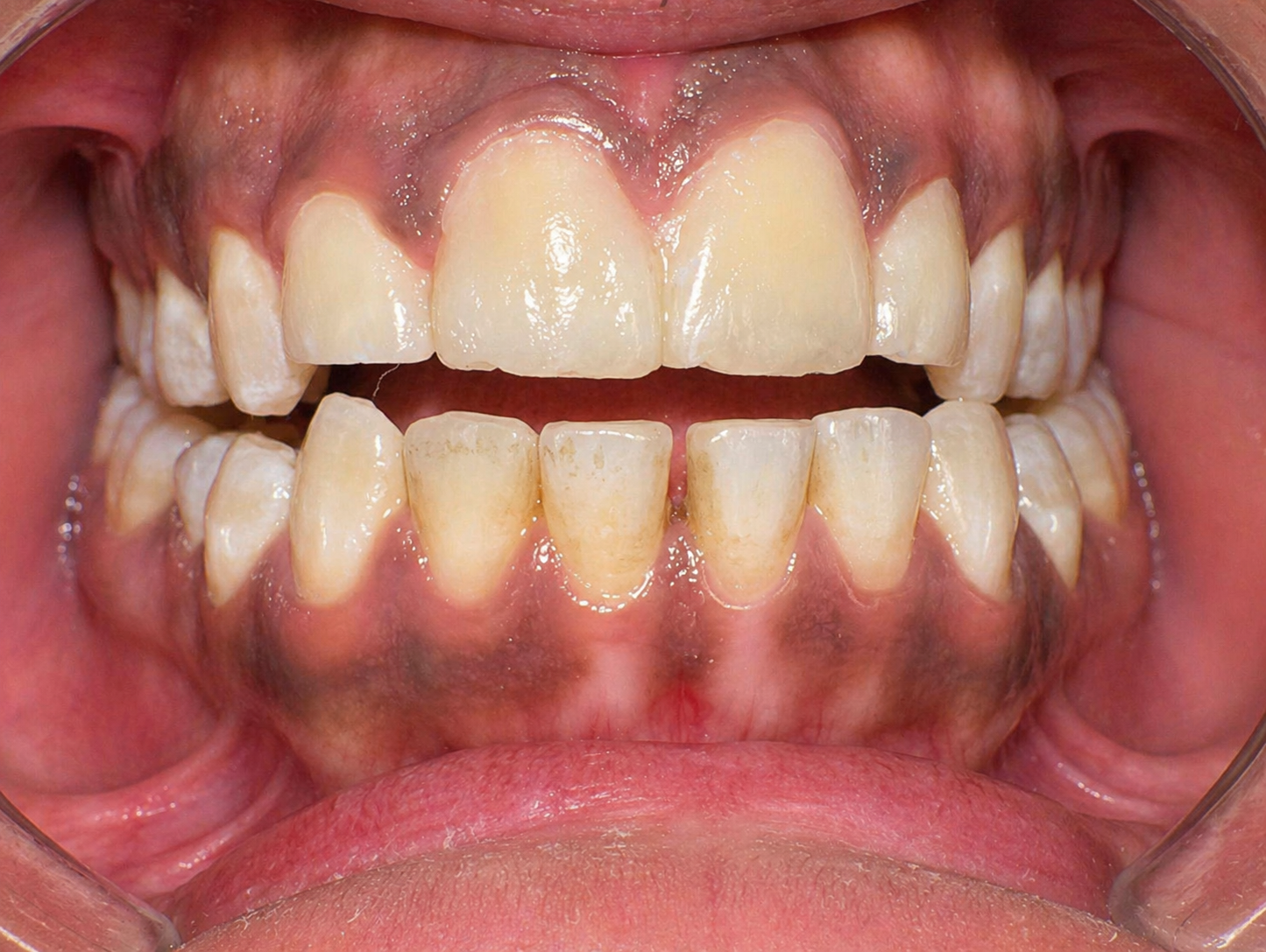 Gap closure & smile correction result